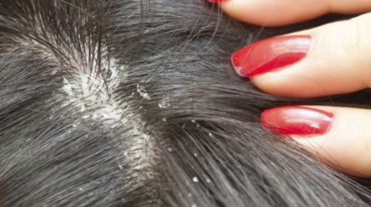 Rüyada Saçında Kepek Görmek Rüya Yorumu ve Anlamı